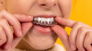 小児歯列矯正について