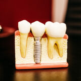 歯の根っこを生成する「根幹治療」とは？治療の流れと期間について